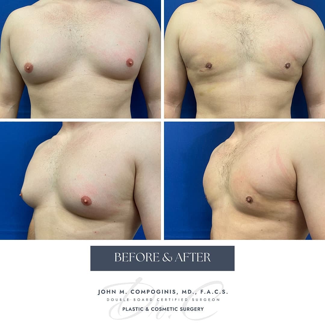 Gynecomastia Before & After