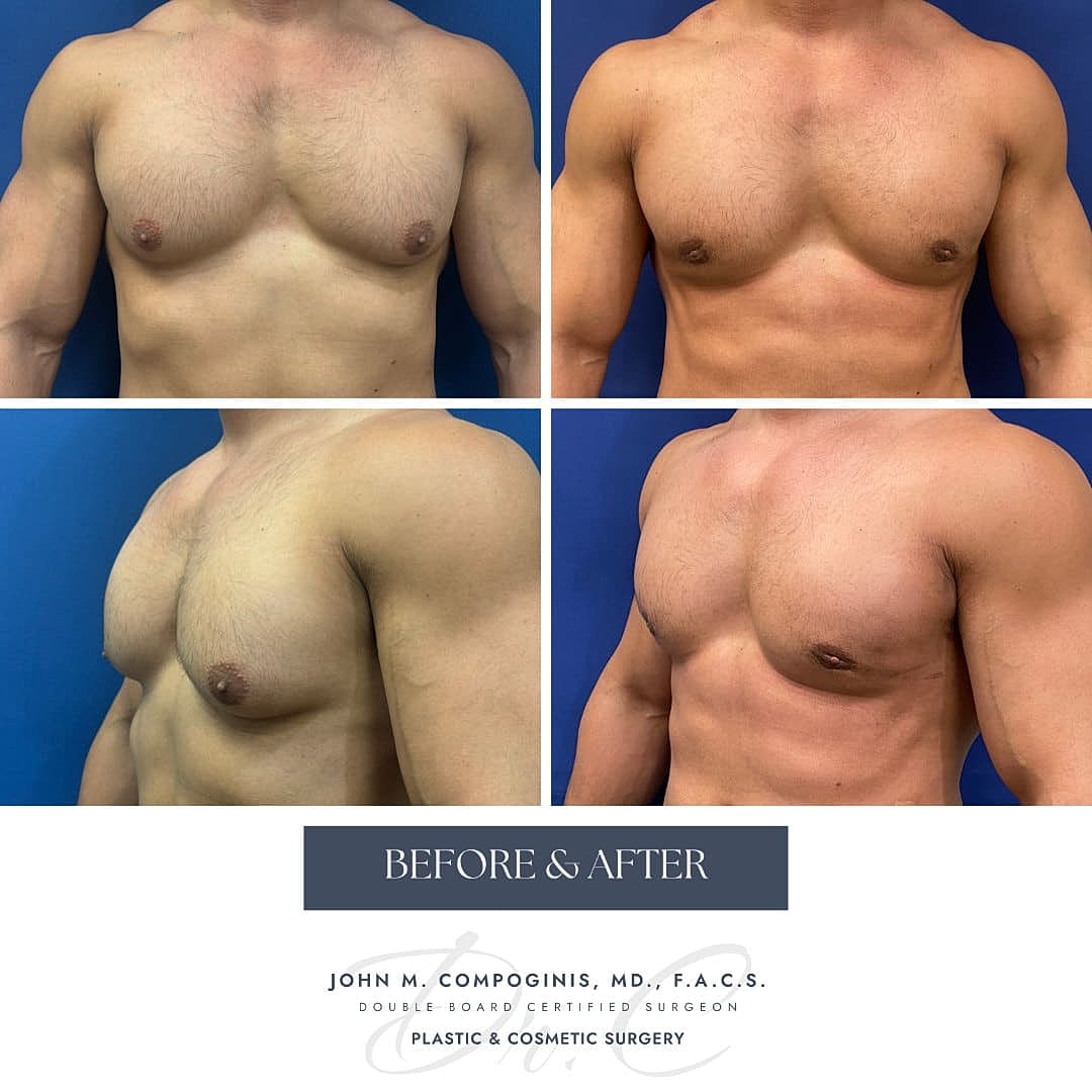 Gynecomastia Before & After