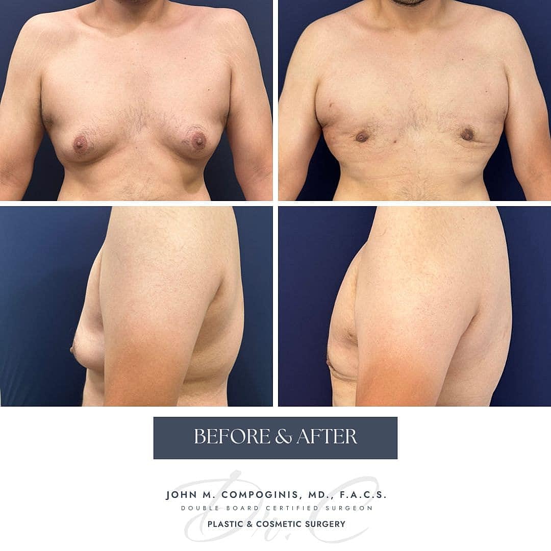 Gynecomastia Before & After