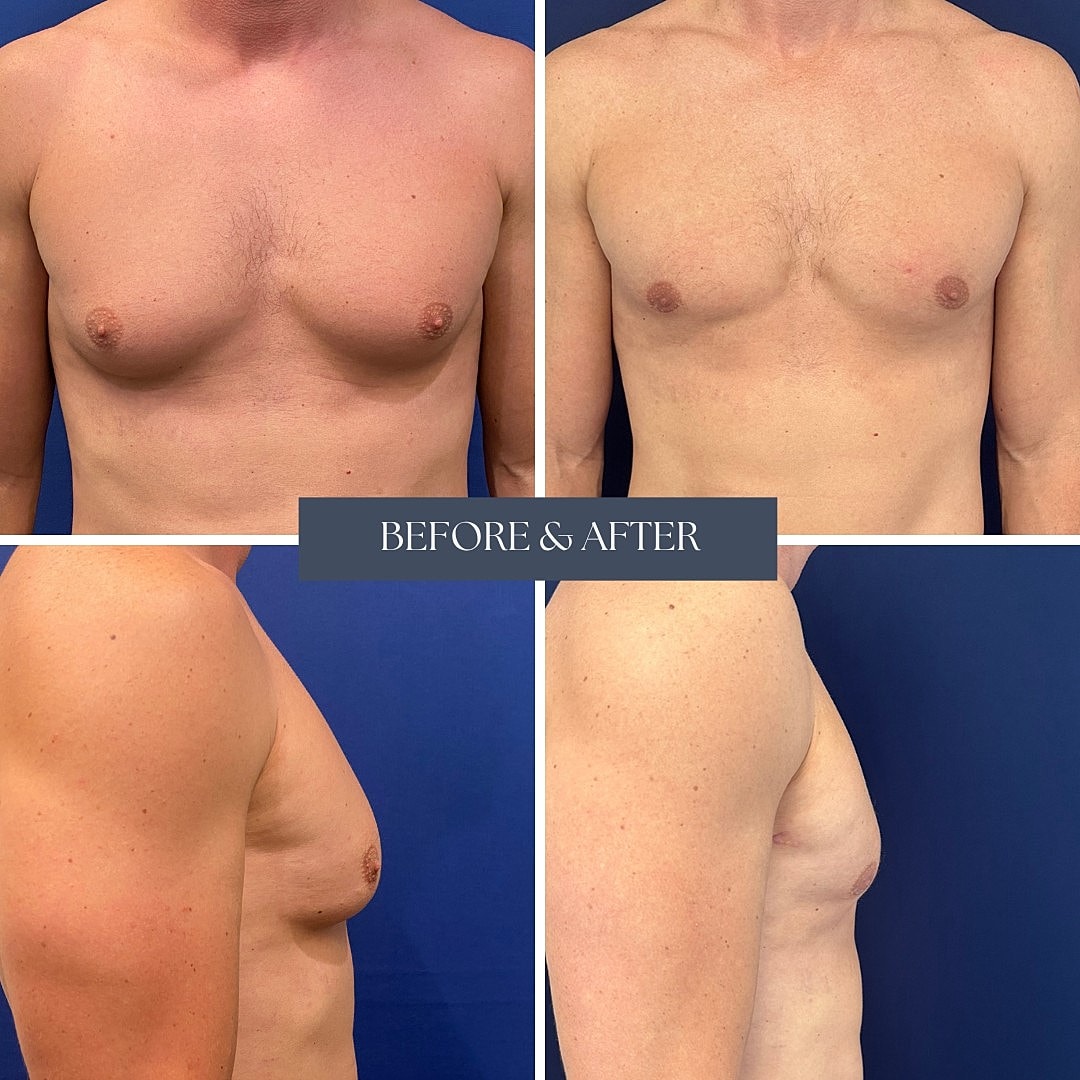 Gynecomastia surgery before and after results.