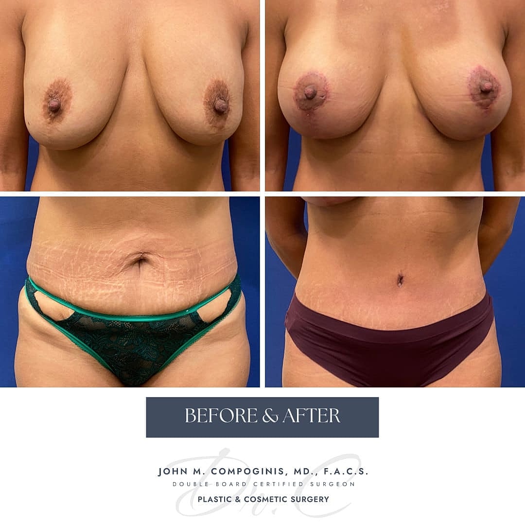 Mommy Makeover Before & After