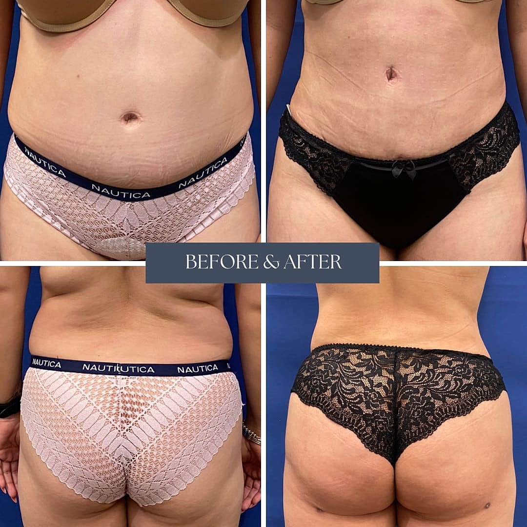 Mommy Makeover Before & After