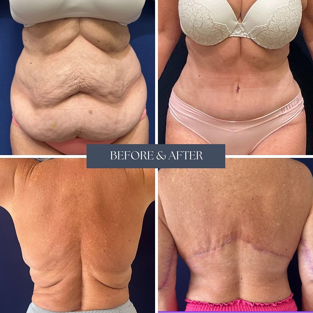 Before and after body transformation comparison.