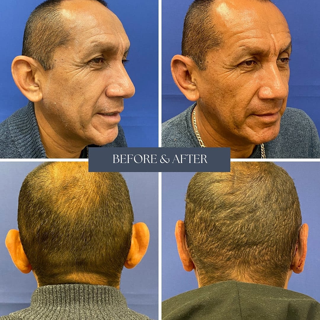 Procedimientos En Las Orejas Before & After