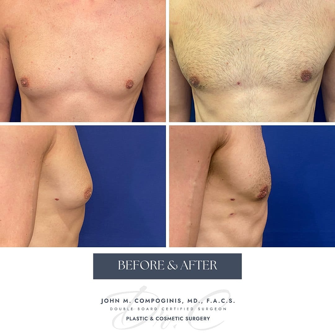 Ginecomastia Before & After