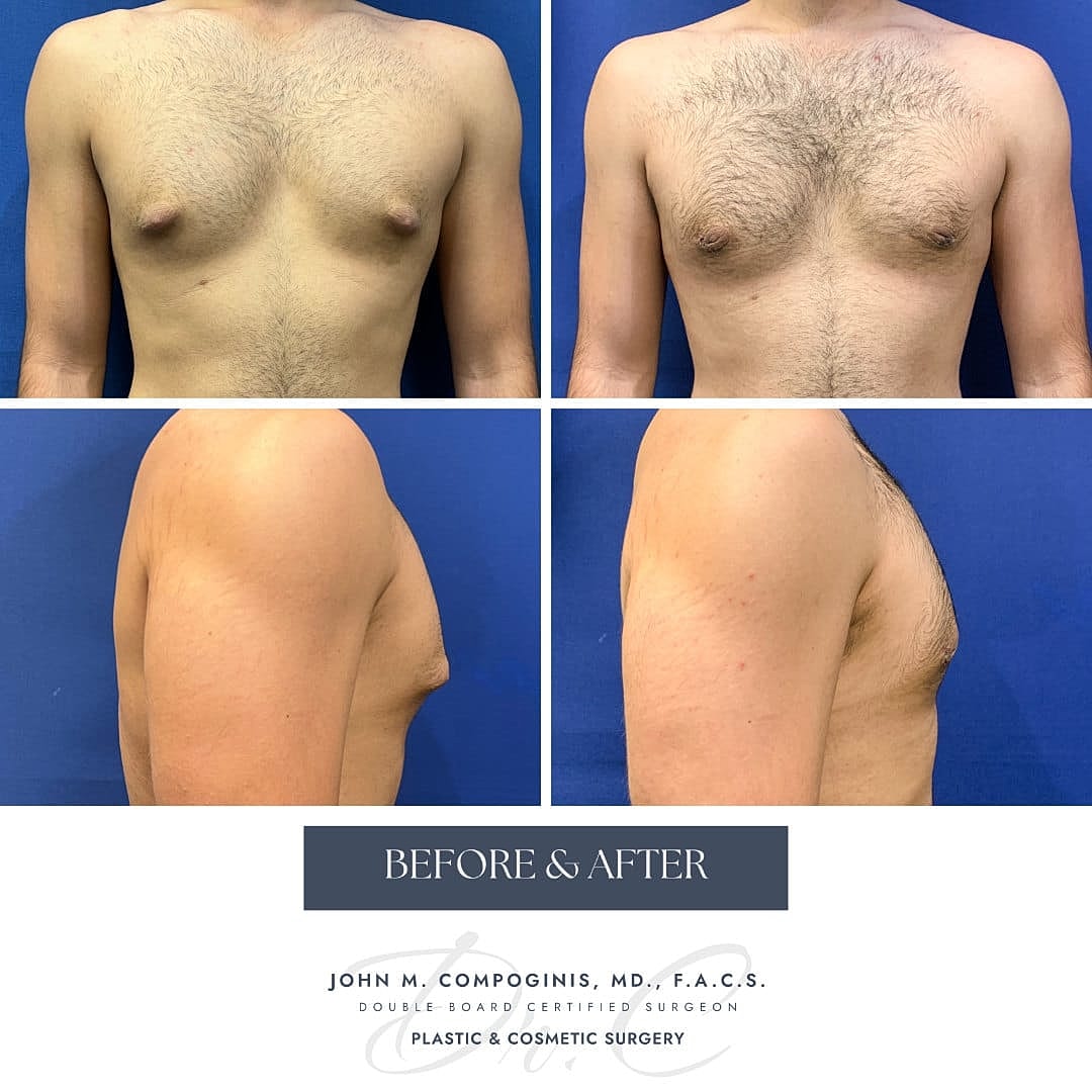 Ginecomastia Before & After