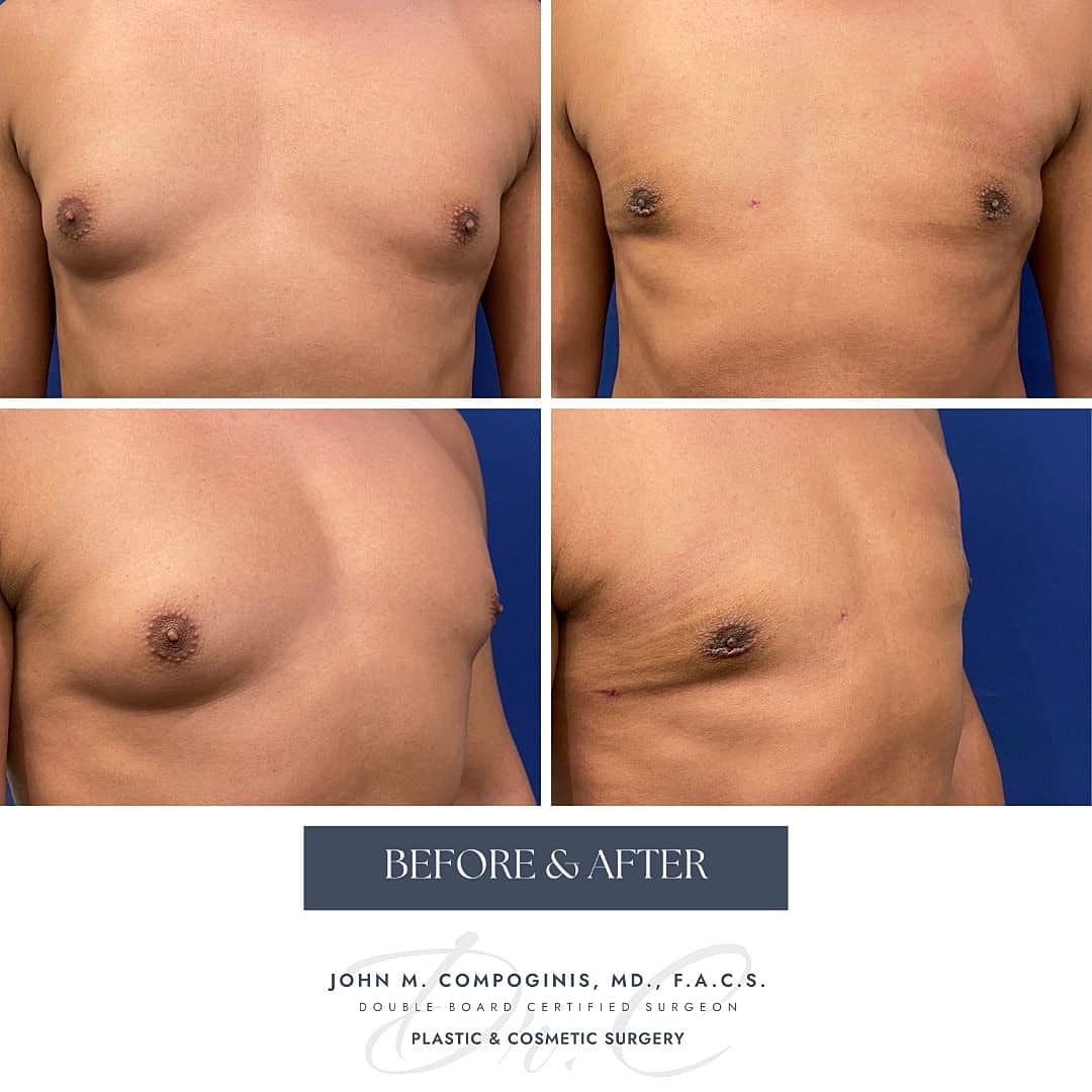 Ginecomastia Before & After