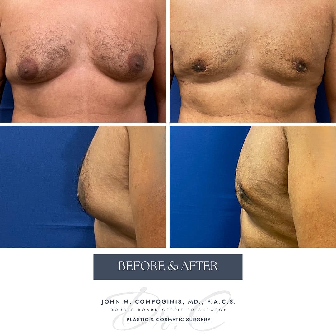 Ginecomastia Before & After