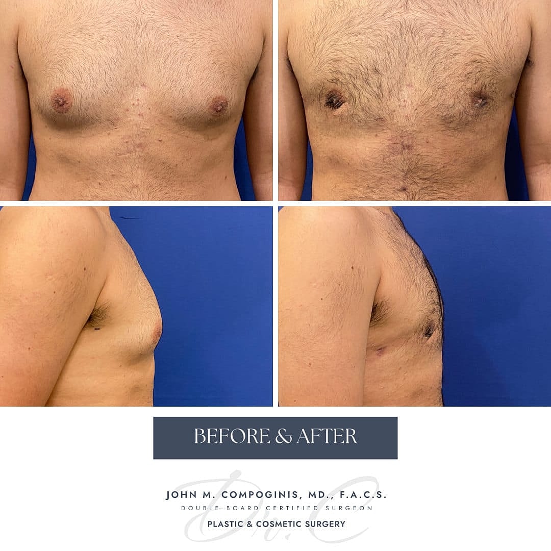 Ginecomastia Before & After