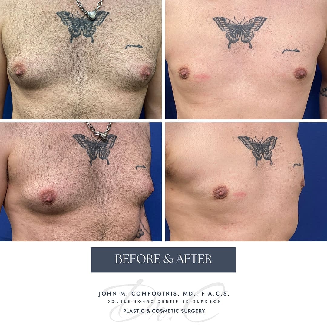 Ginecomastia Before & After