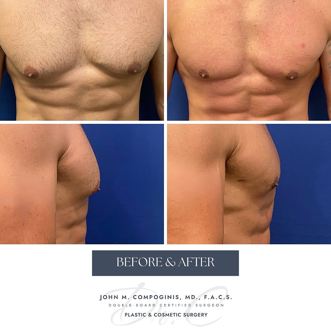 Ginecomastia Before & After