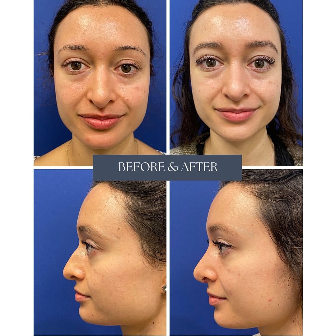 Rhinoplasty Before & After