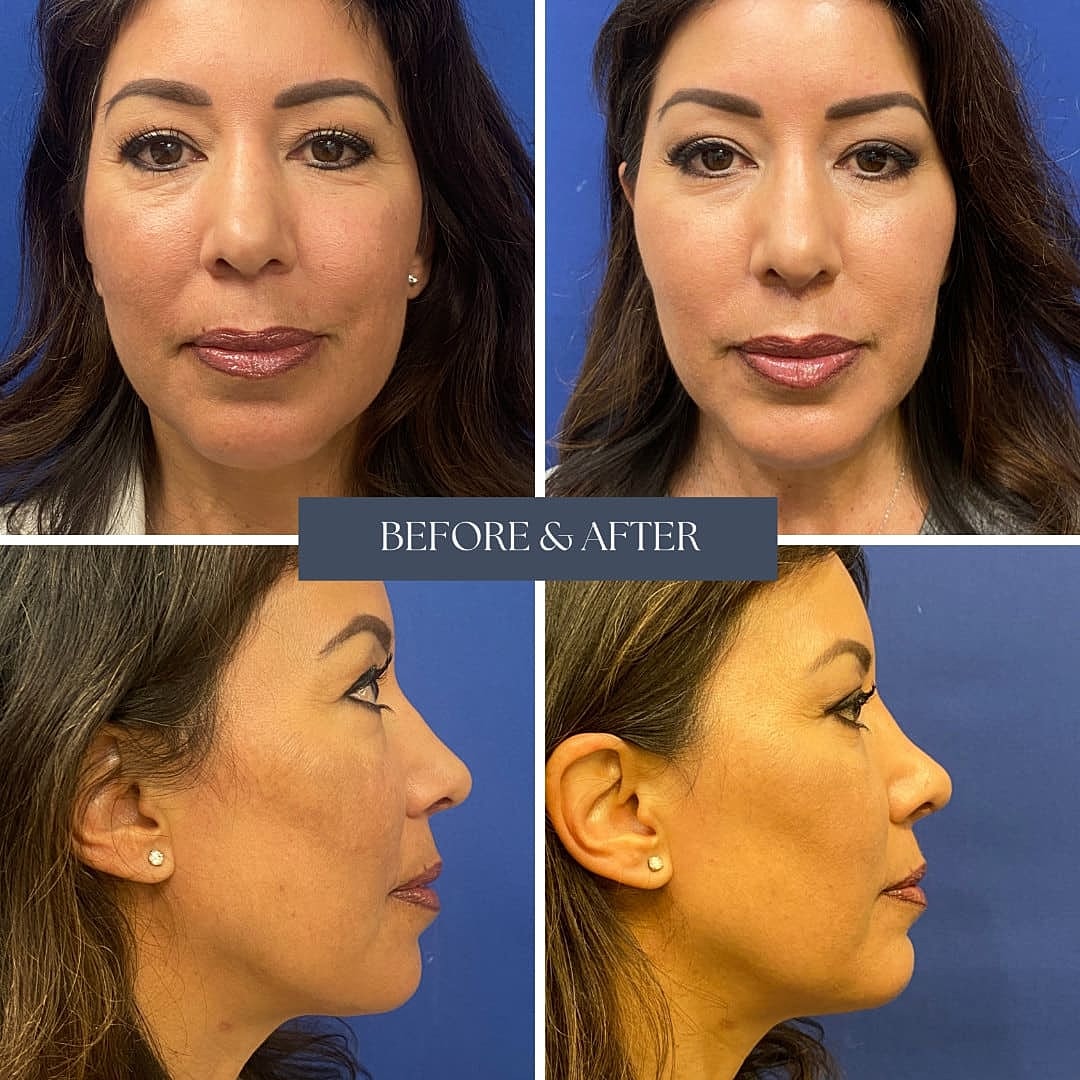 Rhinoplasty Before & After
