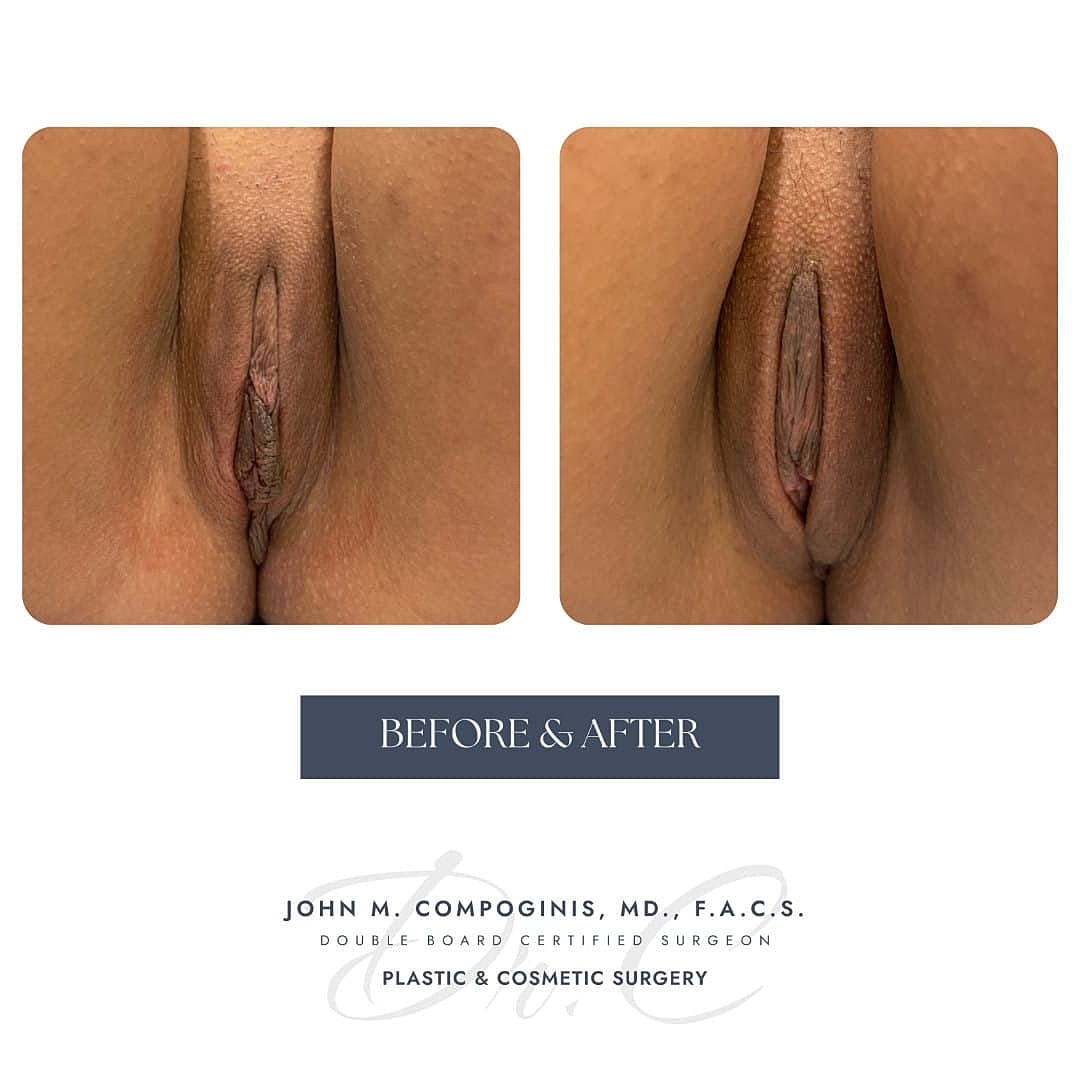 Labiaplasty Before & After