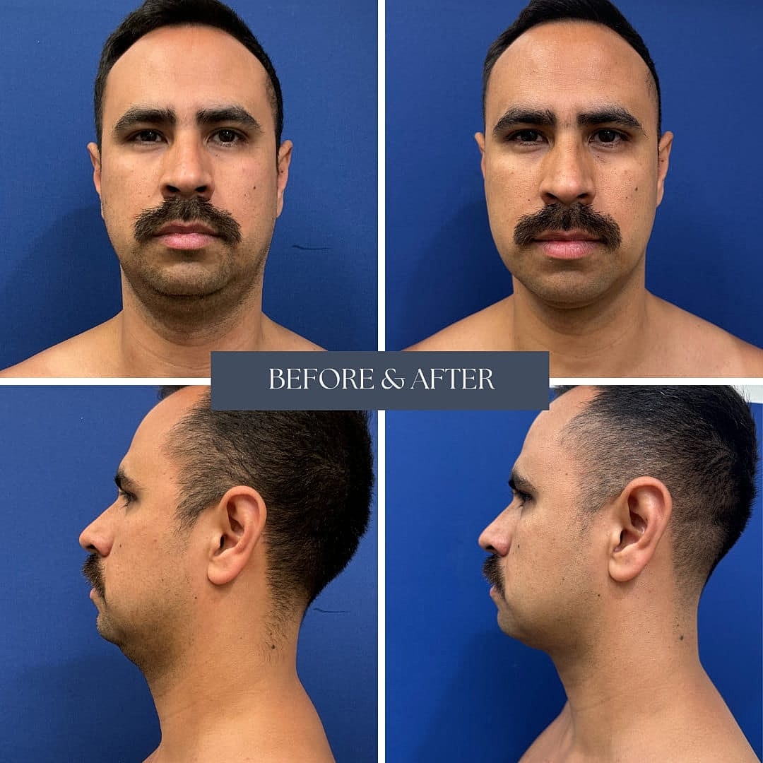 Liposuction Before & After