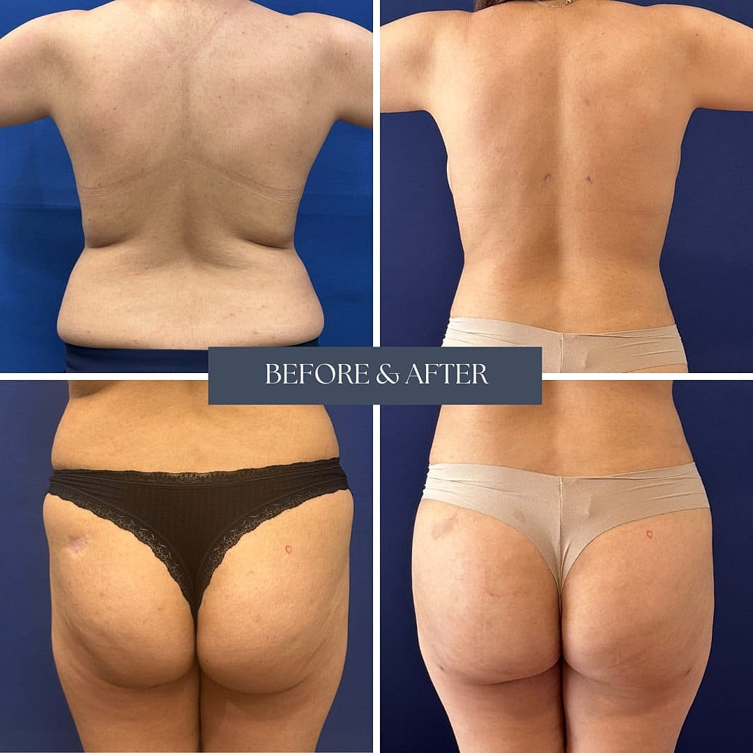 Liposuction Before & After