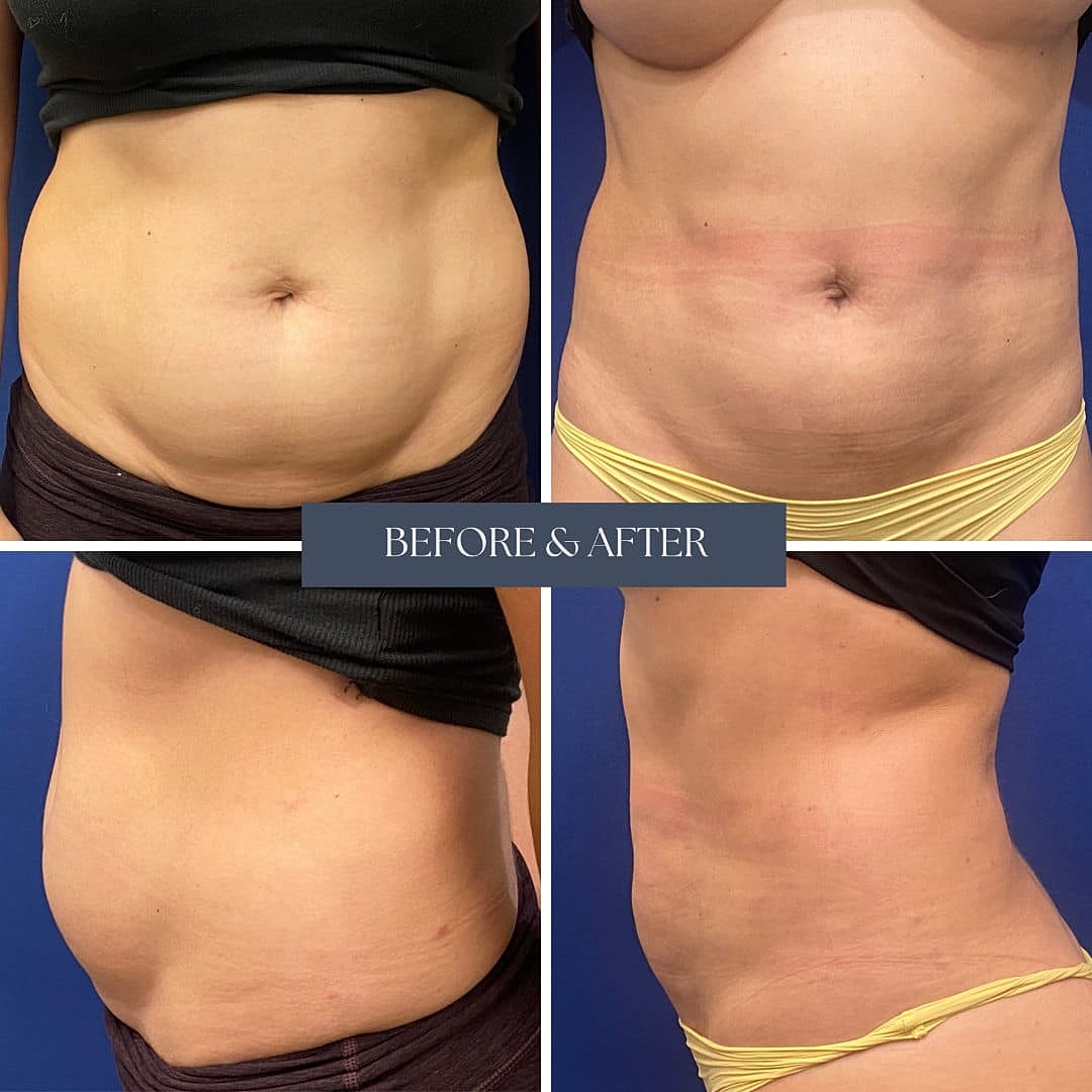 Liposuction Before & After