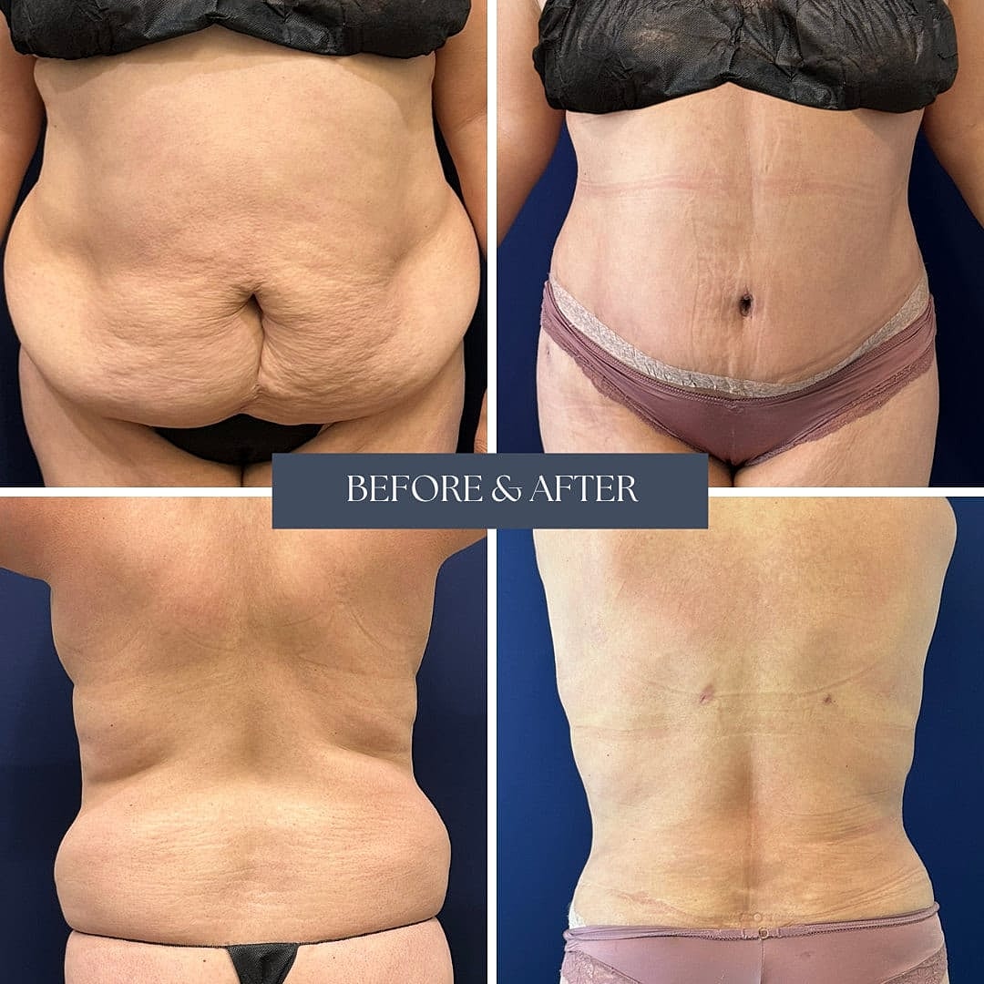 Tummy Tuck Before & After
