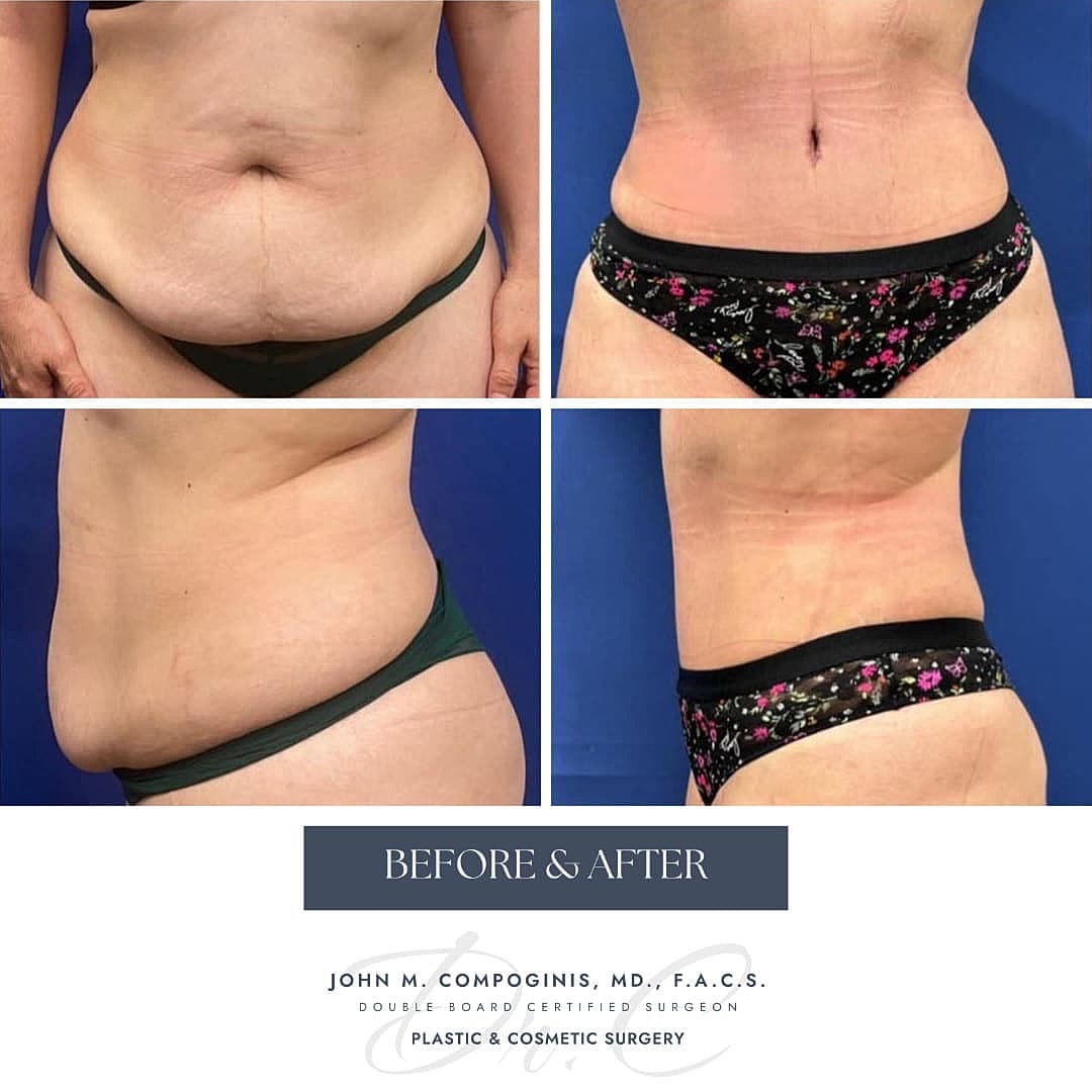 Tummy Tuck Before & After