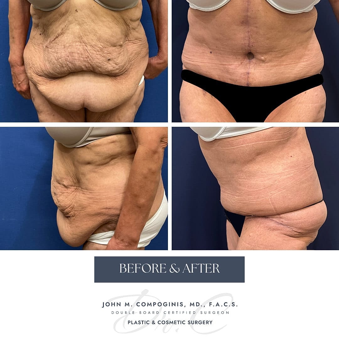 Tummy Tuck Before & After