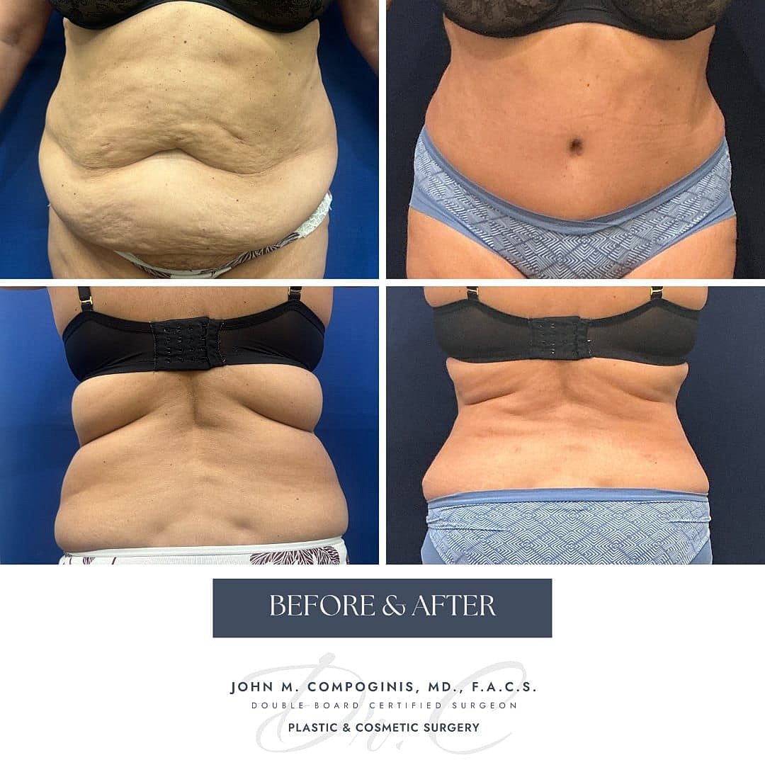 Tummy Tuck Before & After