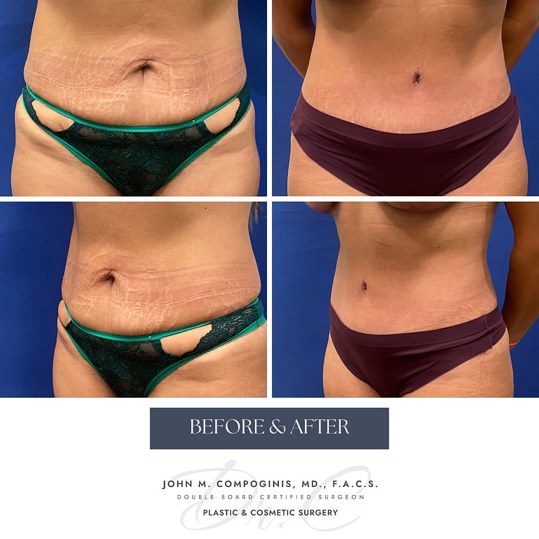 Tummy Tuck Before & After