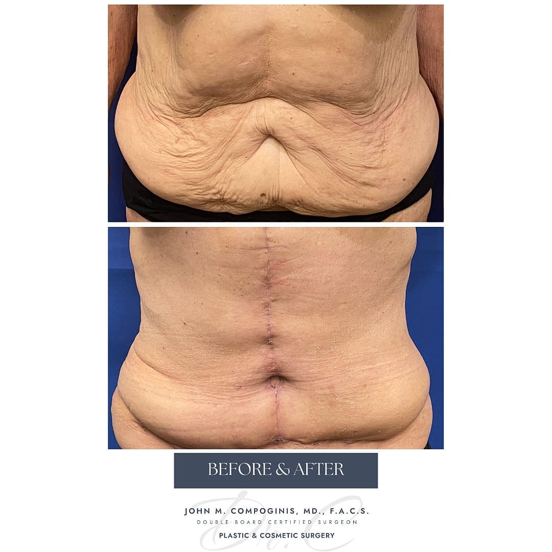 Tummy Tuck Before & After