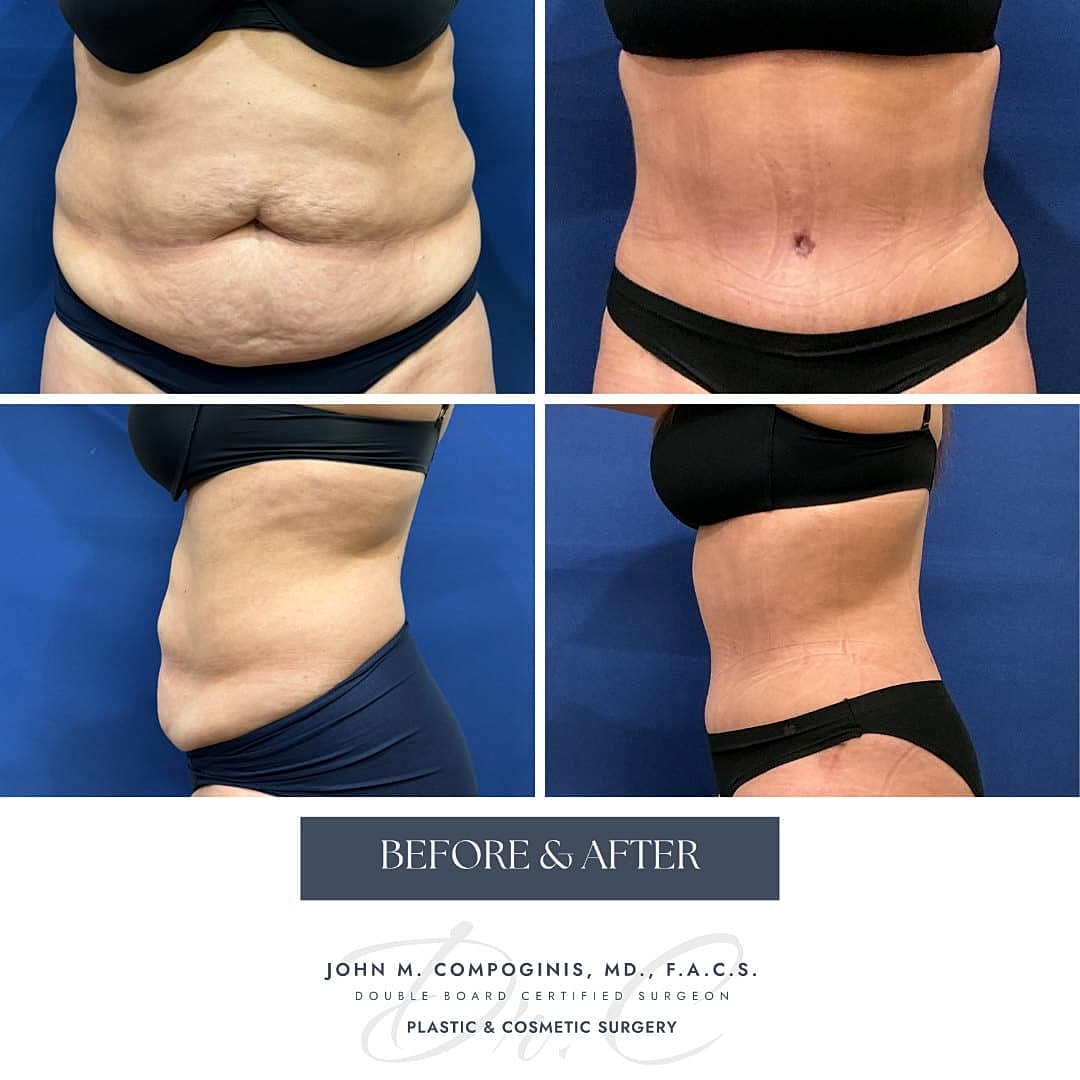 Tummy Tuck Before & After