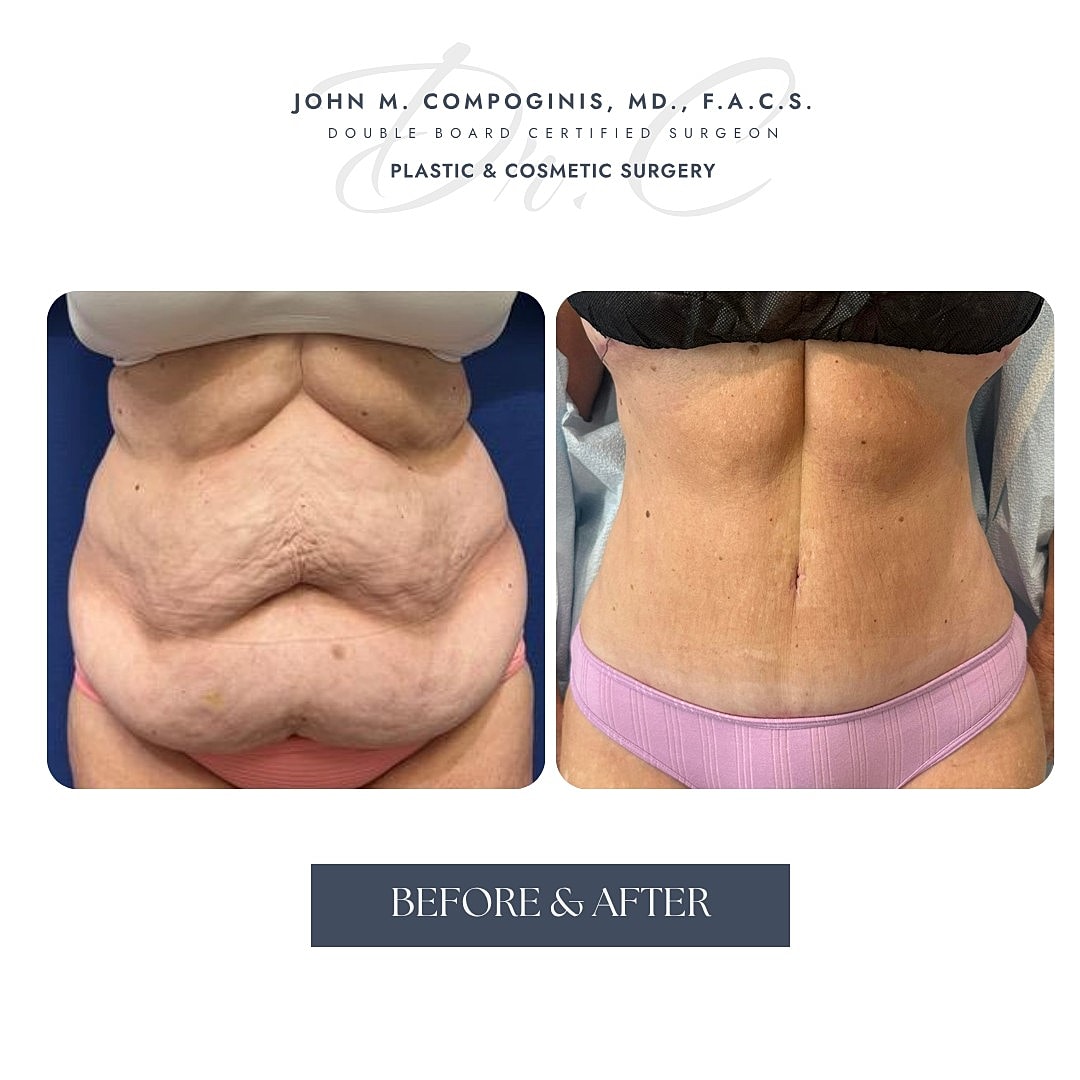 Before and after plastic surgery body transformation.