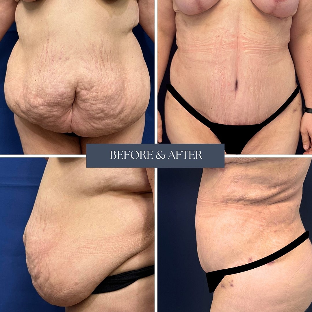 Body transformation before and after cosmetic procedure