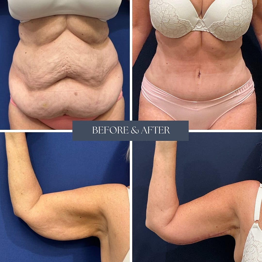 Transformacion Mama Before & After