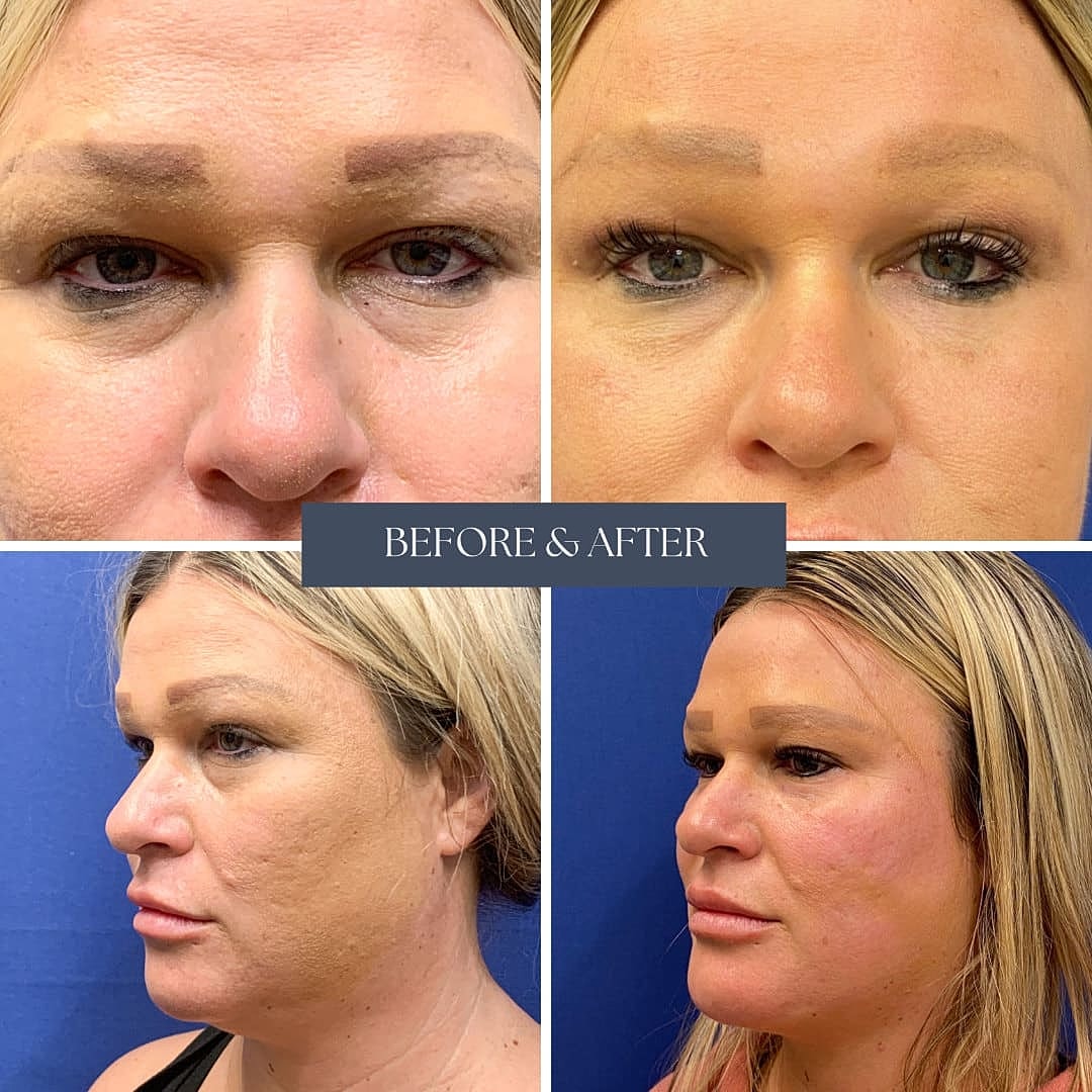 Fat Grafting Before & After