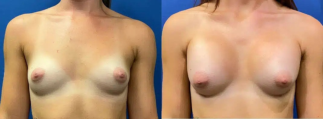 Aumento De Senos Before & After