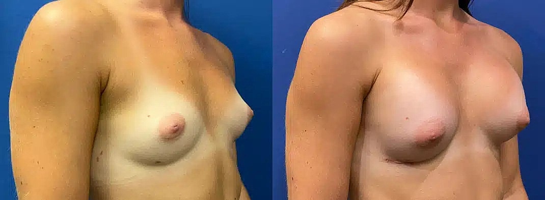 Aumento De Senos Before & After