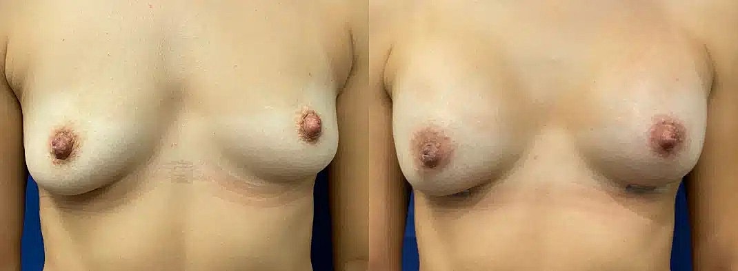 Aumento De Senos Before & After