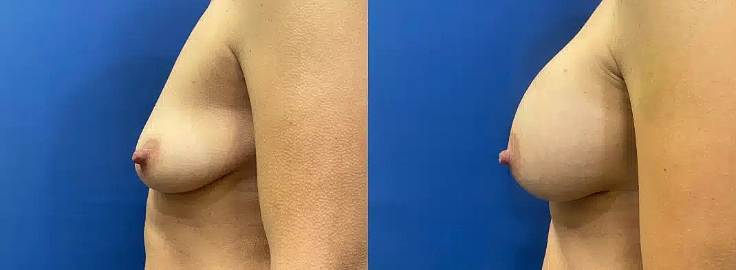 Aumento De Senos Before & After
