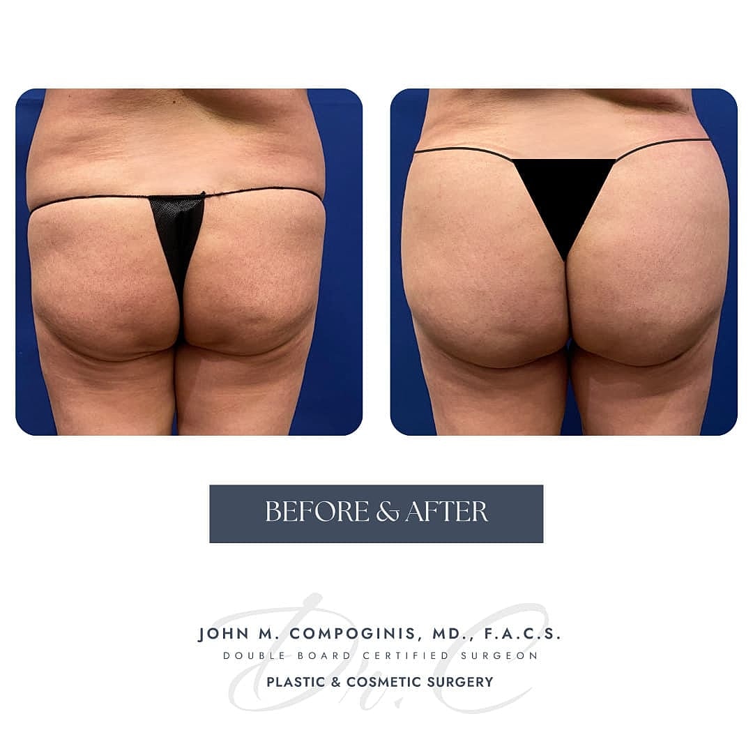 Brazilian Butt Lift Before & After
