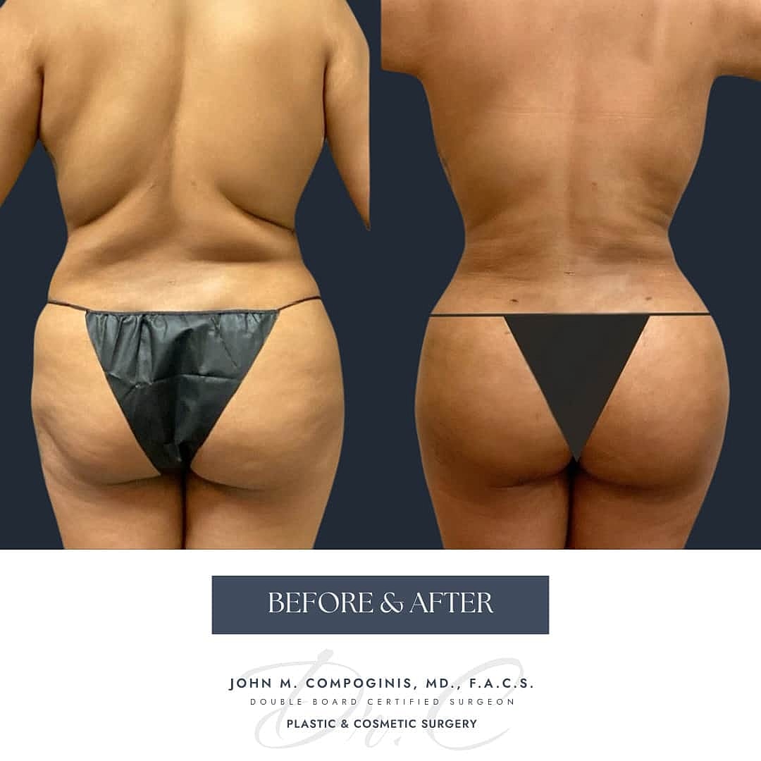 Brazilian Butt Lift Before & After