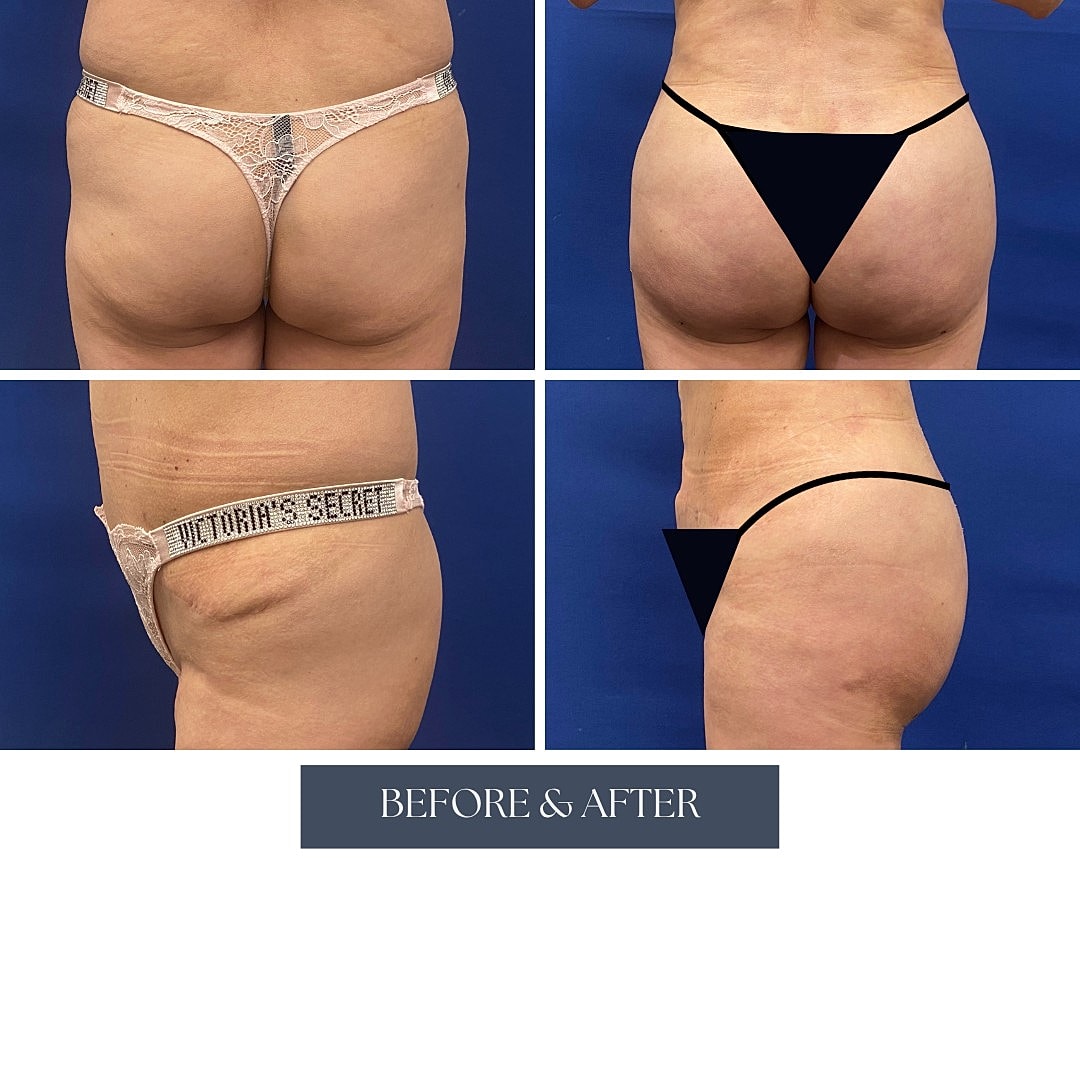 Before and after comparison of thong underwear.
