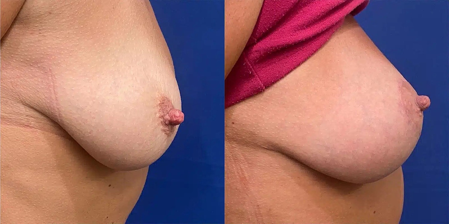 Levantamiento De Senos Before & After