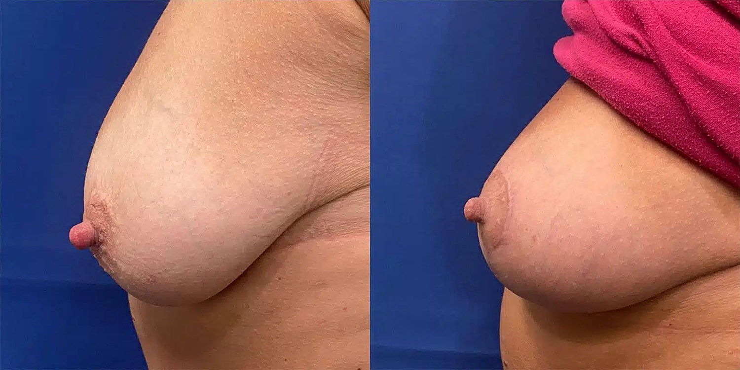 Levantamiento De Senos Before & After