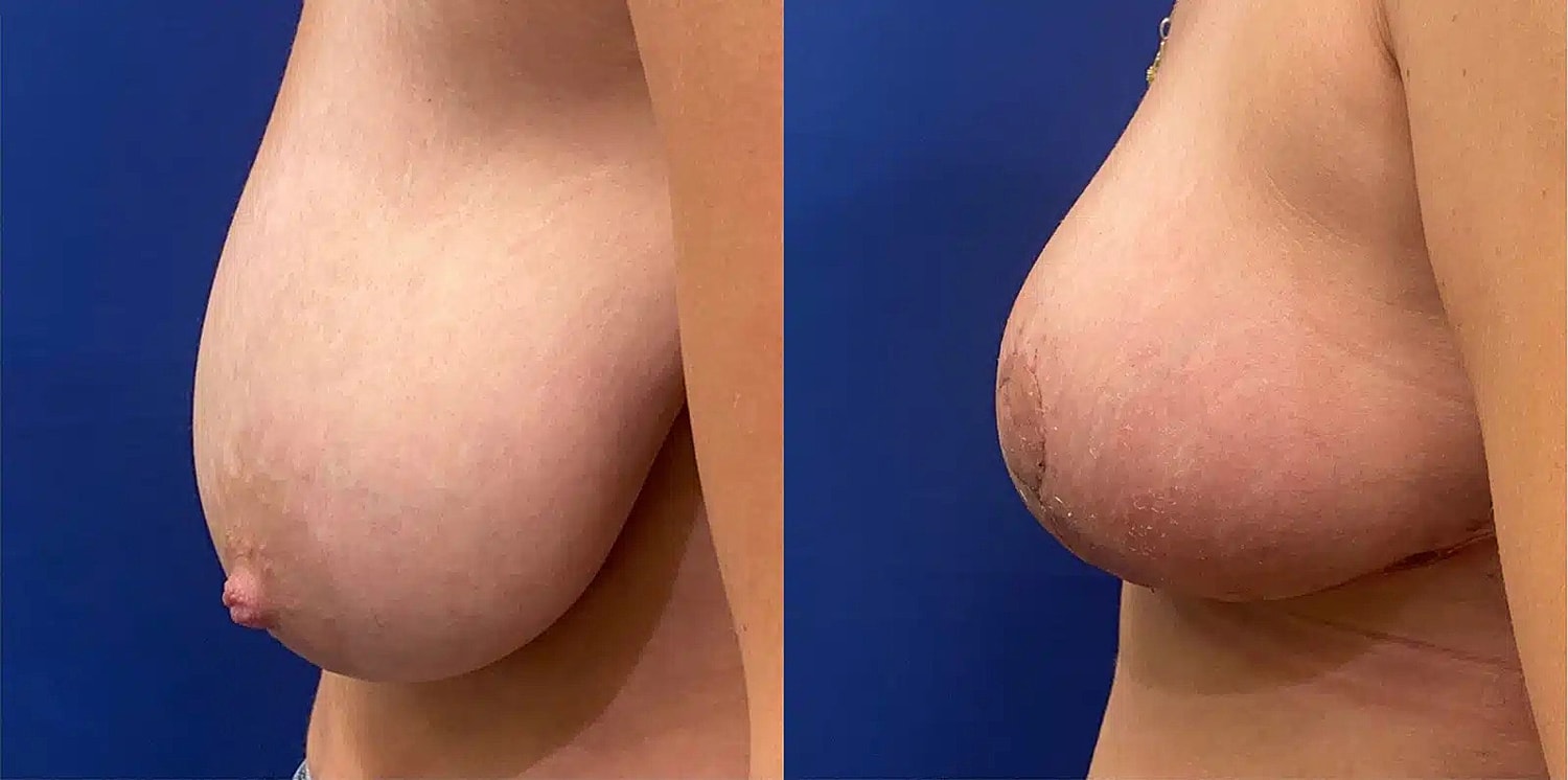 Levantamiento De Senos Before & After