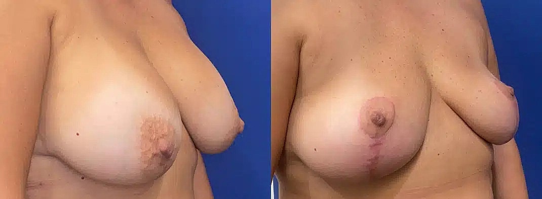 Levantamiento De Senos Before & After