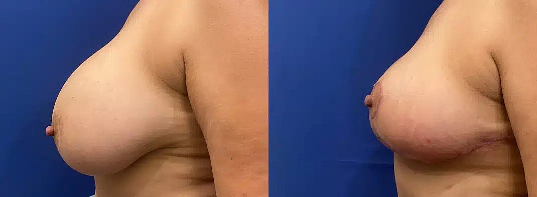 Levantamiento De Senos Before & After