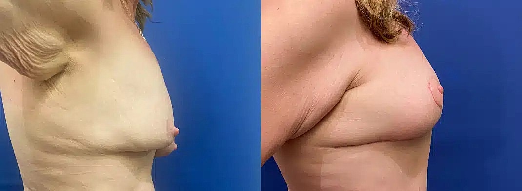 Levantamiento De Senos Before & After