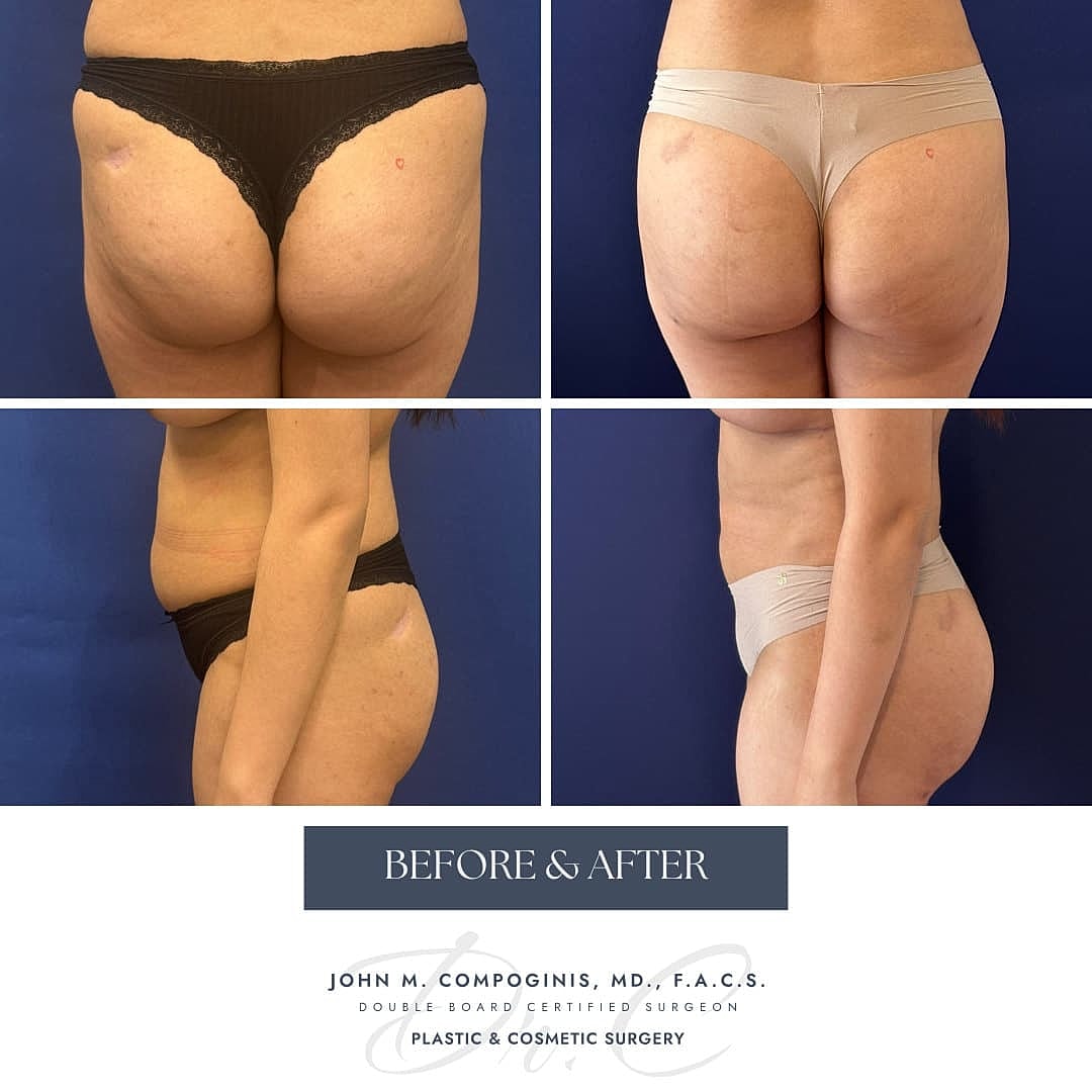 BBL Brasileno Before & After