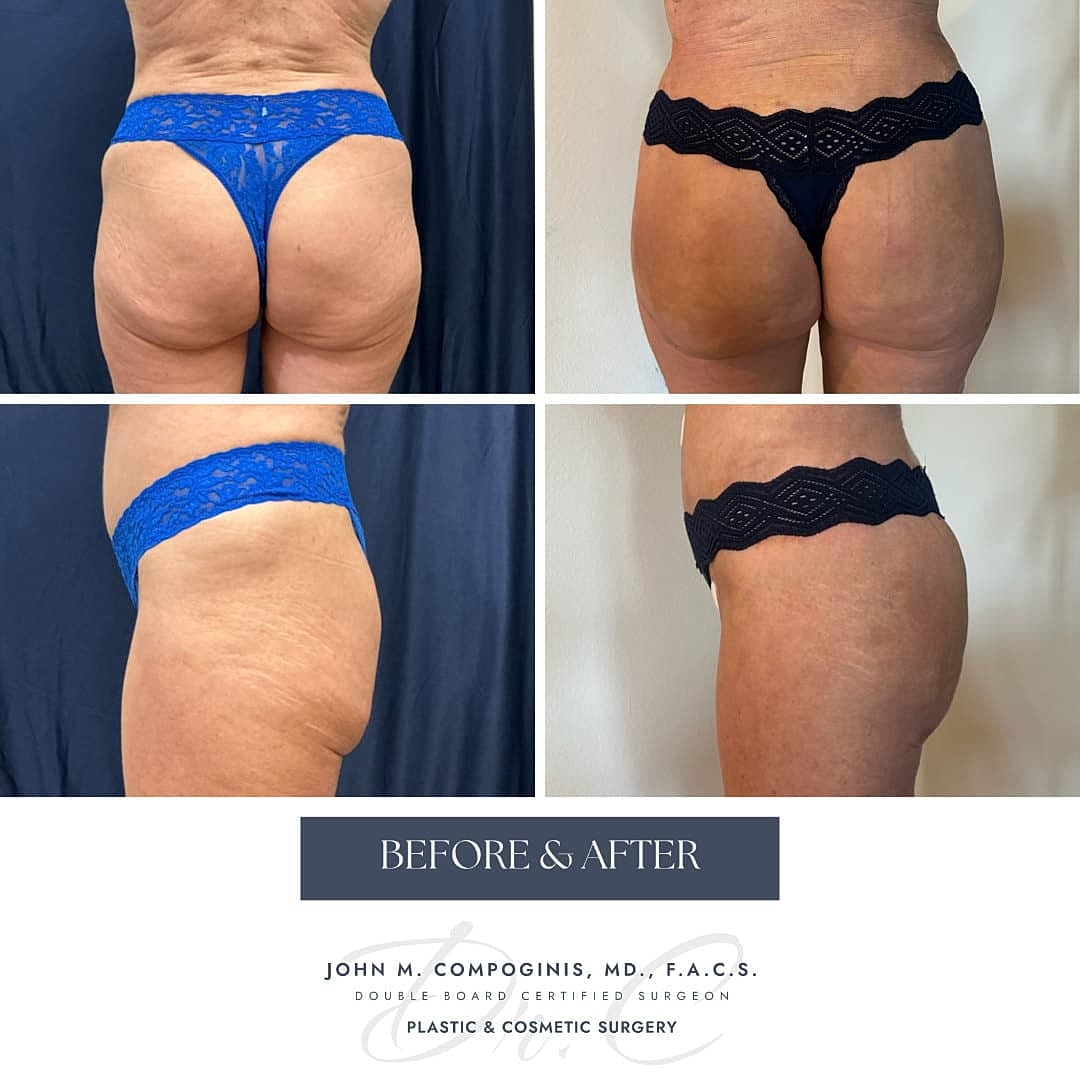 BBL Brasileno Before & After