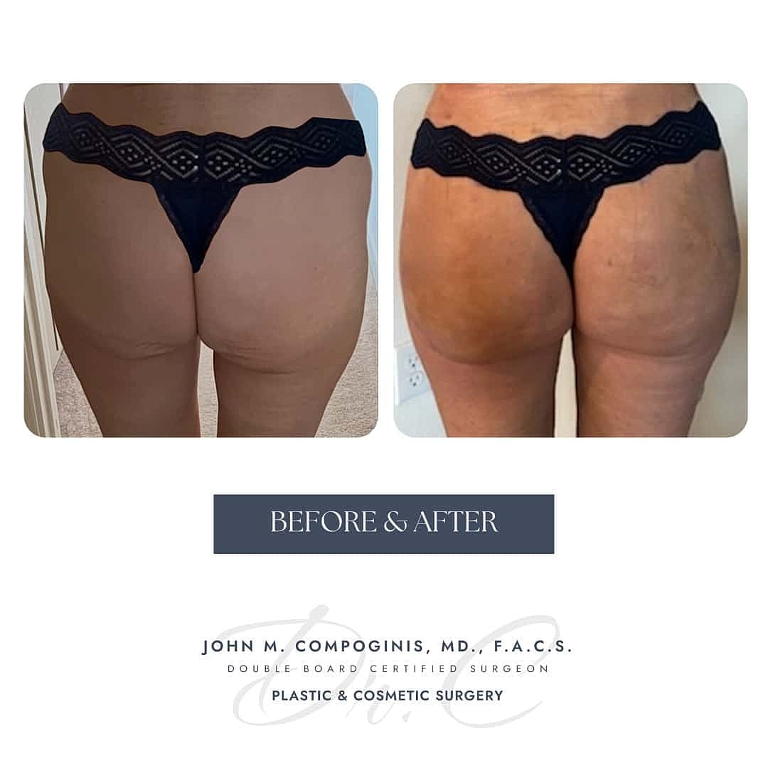 BBL Brasileno Before & After