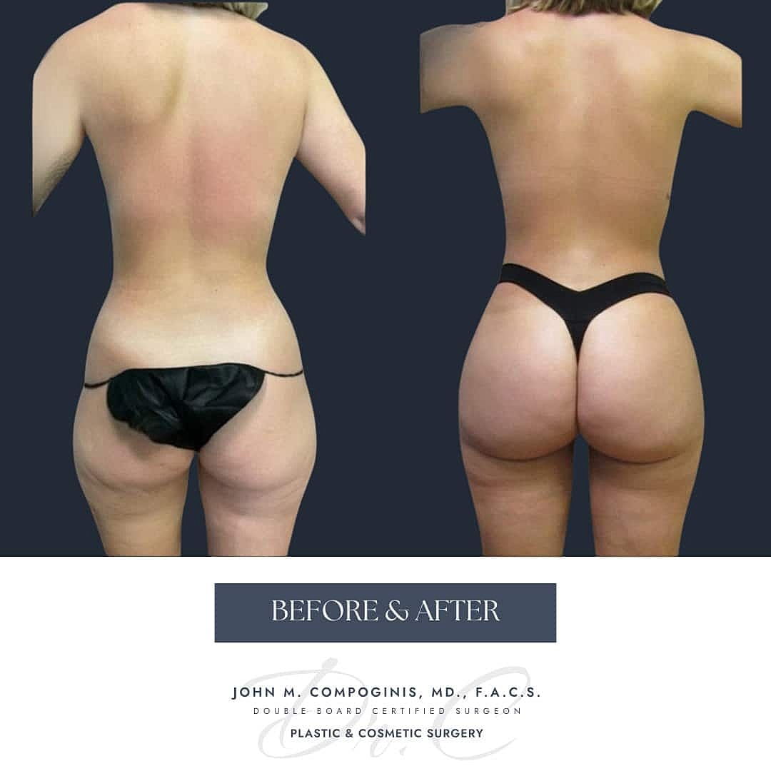 BBL Brasileno Before & After
