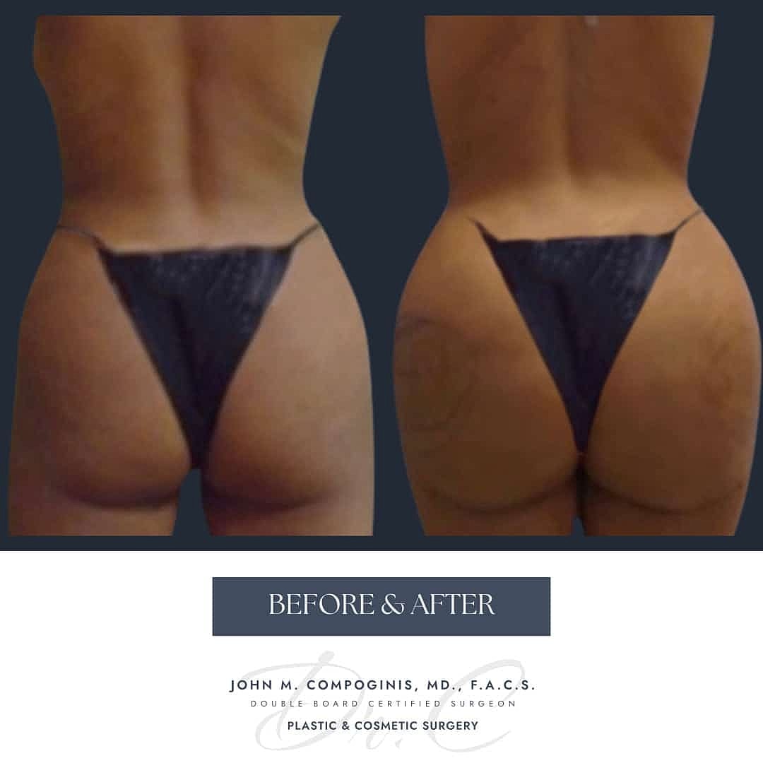 BBL Brasileno Before & After